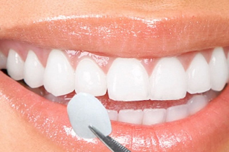 Có nên bọc răng sứ không là thắc mắc chung của nhiều người gặp các vấn đề về răng miệng