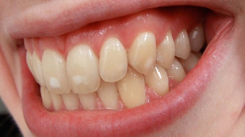 Răng bị xỉn màu là trường hợp nên bọc răng sứ