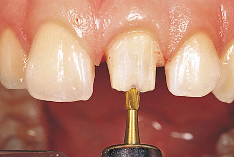 Mài răng bọc sứ có phức tạp không là băn khoăn của nhiều người
