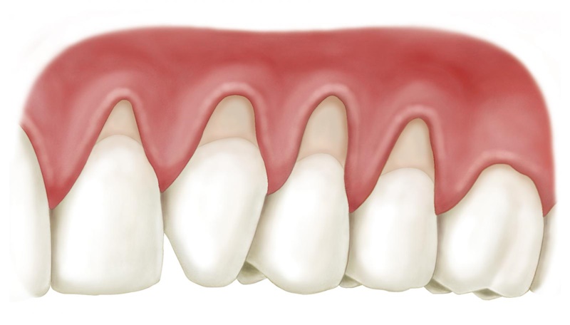 Bị tụt nướu khi đánh răng dễ bị chảy máu chân răng.