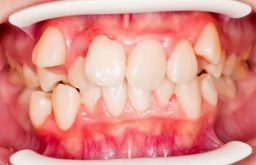 [Tìm hiểu ngay] Răng khấp khểnh là gì? Cách khắc phục hiệu quả