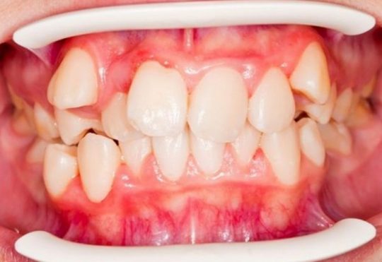 [Tìm hiểu ngay] Răng khấp khểnh là gì? Cách khắc phục hiệu quả