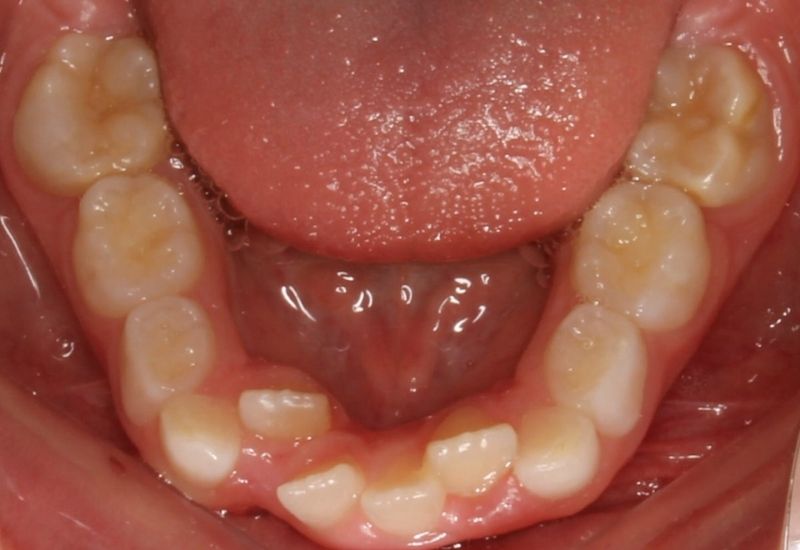 Nguyên nhân gây ra tình trạng răng khấp khểnh rất đa dạng