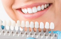 Trước và sau khi bọc răng sứ thẩm mỹ cần lưu ý những gì?