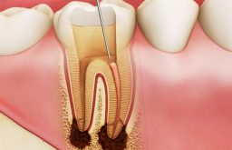 Tủy răng: Cấu tạo, chức năng và một số bệnh lý thường gặp