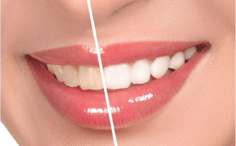 Tẩy trắng răng là phương pháp nha khoa được nhiều người áp dụng