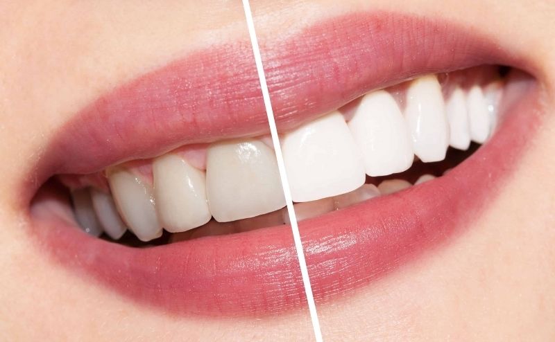 Tẩy trắng răng ở đâu tốt? Nha khoa I-Dent mang đến công nghệ hiện đại cho hiệu quả cao