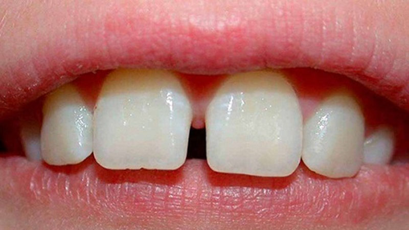 Nhiều người chọn phương pháp niềng răng để khác phục tình trạng răng thưa