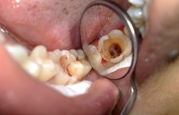 [Giải Đáp]: Viêm Tủy Răng Là Gì? Triệu Chứng Và Cách Chữa Phổ Biến