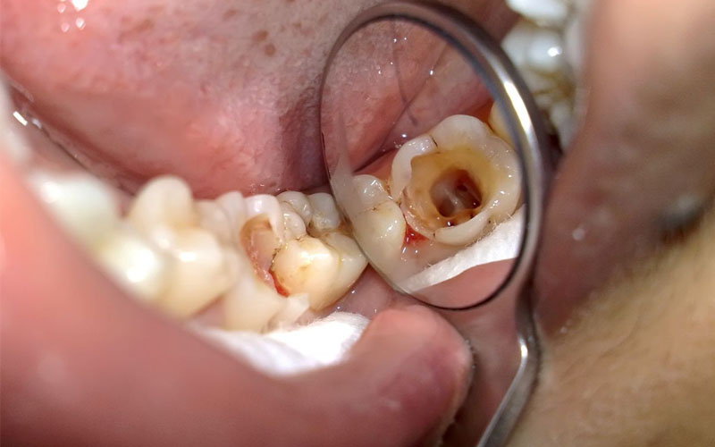 Viêm tủy răng là bệnh lý nha khoa phổ biến nhiều người gặp phải