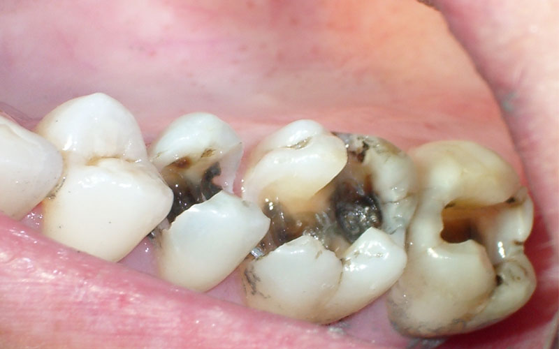 Sâu răng là một trong những nguyên nhân hàng đầu dẫn đến tình trạng này