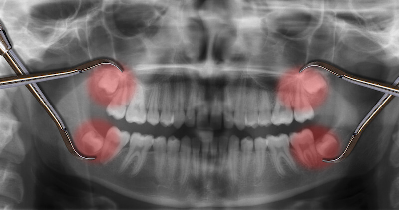 Vị trí răng khôn trên hàm răng người trưởng thành