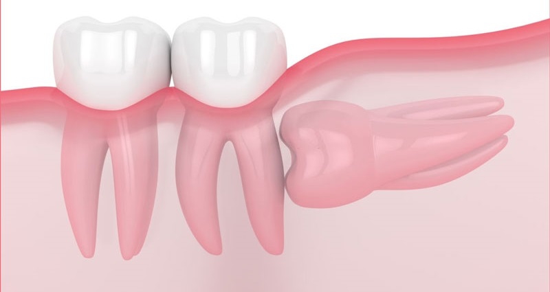 Nhổ răng khôn mọc lệch bao nhiêu sẽ phụ thuộc vào nhiều yếu tố