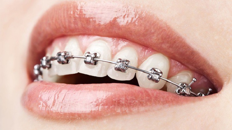 Chi phí niềng răng 2 hàm với mắc cài kim loại là rẻ nhất