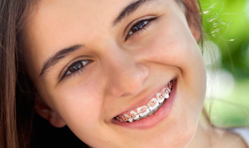 Nên niềng răng cho trẻ trong giai đoạn từ 10 - 18 tuổi