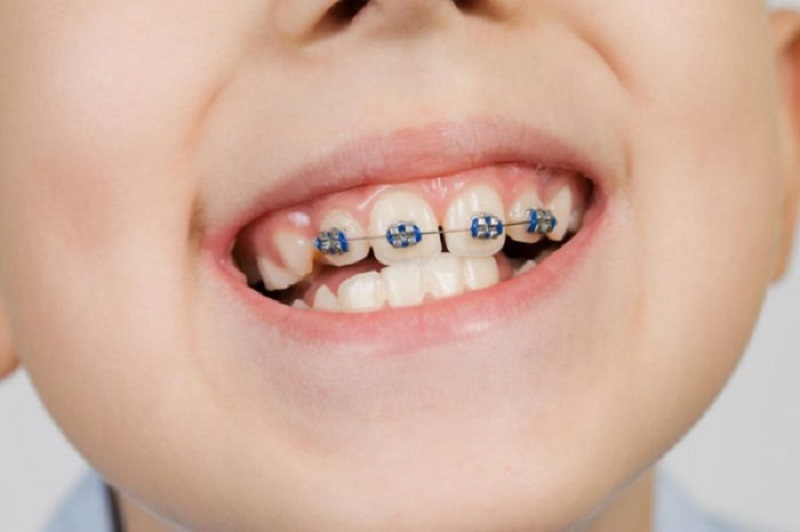 Trẻ bao nhiêu tuổi thì niềng răng được và thời gian niềng sẽ phụ thuộc vào nhiều yếu tố