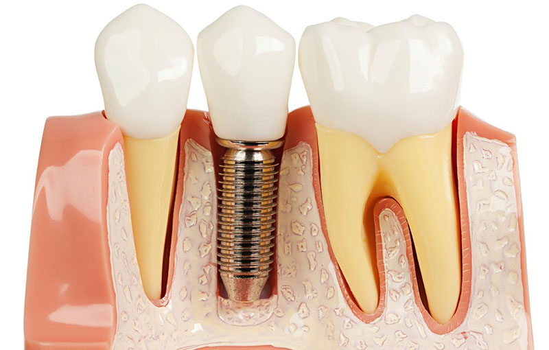 Trồng răng implant cho phép bạn sở hữu một chiếc răng khểnh vĩnh viễn