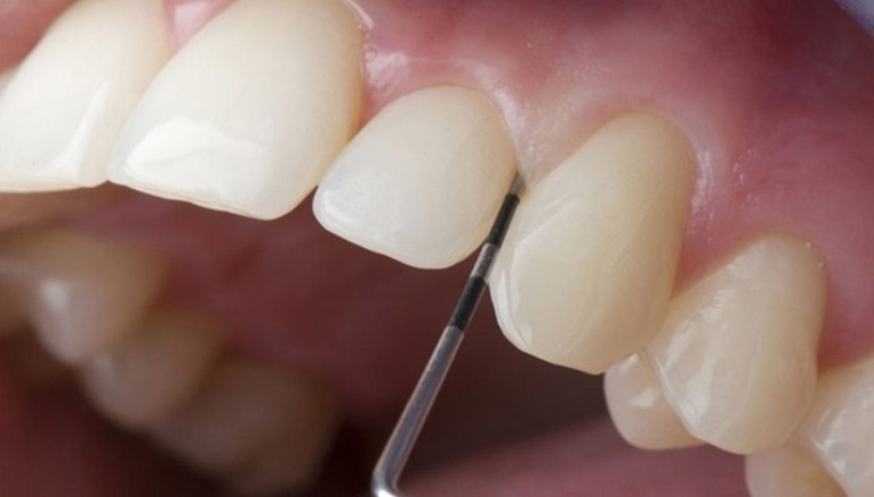 Cầu răng sứ là phương pháp dùng 2 thân răng sứ để tạo răng khểnh