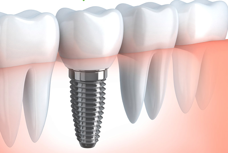 Cấy ghép implant là phương pháp trồng răng có thể sử dụng vĩnh viễn