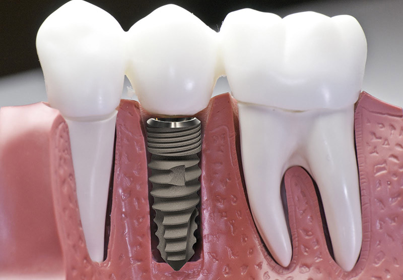 Phân loại răng sứ theo chất liệu phần trụ Implant