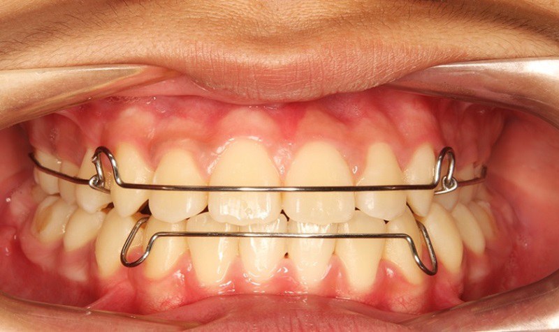 Không đeo hàm duy trì, răng dễ chạy về vị trí cũ