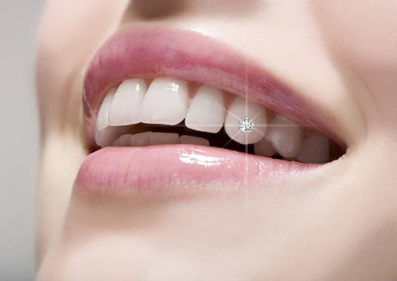 Việc đính đá hoặc kim cương lên răng hoàn toàn không gây hại tới sức khỏe người dùng