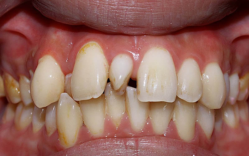 răng lồi xỉ là hiện tượng răng mọc lệch hoàn toàn khỏi khuôn hàm