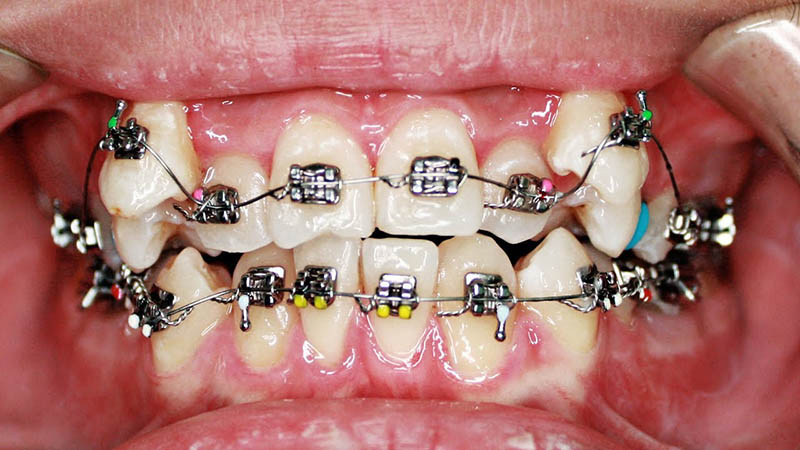 Niềng răng hoặc bọc răng cũng hữu ích trong một số trường hợp