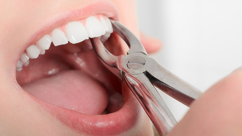Một số trường hợp bác sĩ có thể chỉ định nhổ răng