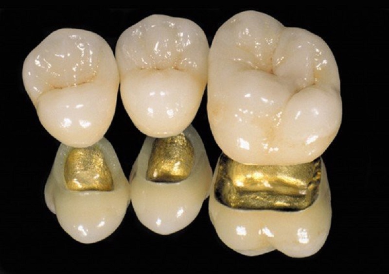 Răng sứ kim loại đá quý (bằng vàng)