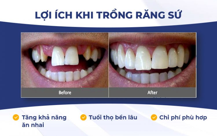 Trồng răng sứ nguyên hàm giúp thăng hạng nhan sắc