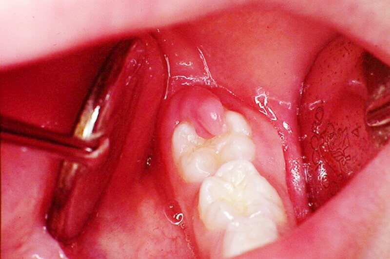 Cắt lợi trùm răng khôn được xếp vào nhóm tiểu phẫu đơn giản trong nha khoa