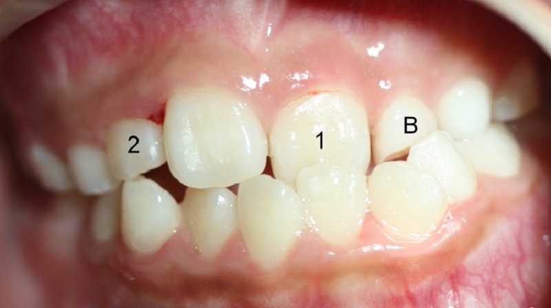 Việc đặt lưỡi sai cách có thể khiến răng bị lệch lạc
