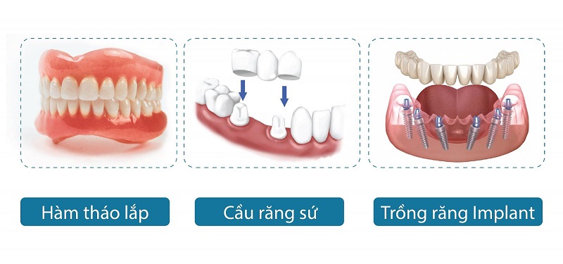 3 phương pháp trồng răng giả phổ biến hiện nay