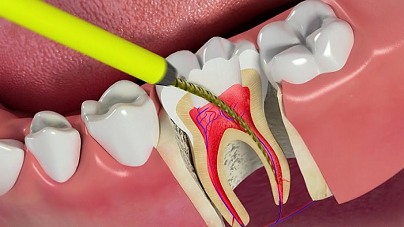 Lấy tủy răng nhằm loại bỏ hoàn toàn phần mô tủy răng bị hoạt tử hoặc viêm nhiễm