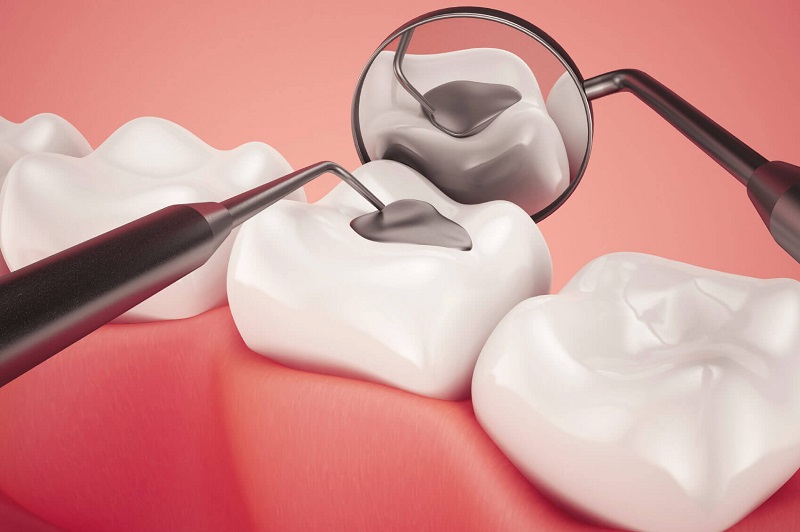 Răng sau khi rút tủy sẽ được trám kín lại để phục hồi hình dáng ban đầu
