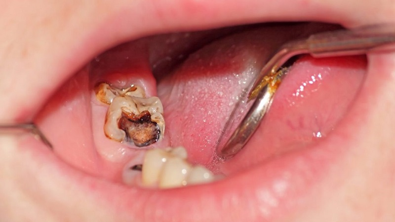 Trẻ cần được điều trị tủy răng nếu thực sự cần thiết