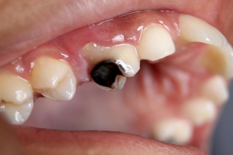 Lấy tủy răng giá bao nhiêu phụ thuộc vào vị trí răng cần loại bỏ tủy