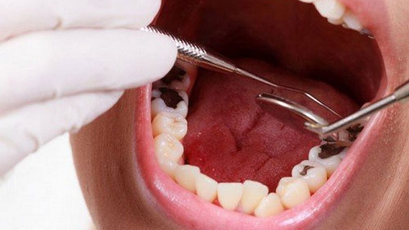 Chữa tuỷ răng bao nhiêu tiền phụ thuộc nhiều vào vị trí răng cần lấy tủy