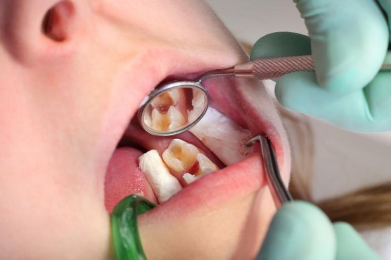Trám răng lấy tủy có đau không hiện vẫn đang là thắc mắc của rất nhiều người