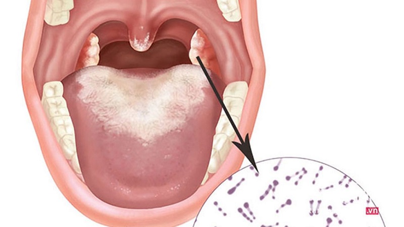 Bệnh bạch sản niêm mạc có thể tiến triển thành ung thư khoang miệng