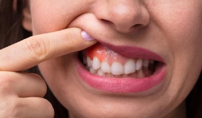 Nguy cơ mắc bệnh răng miệng nghiêm trọng trong mùa dịch