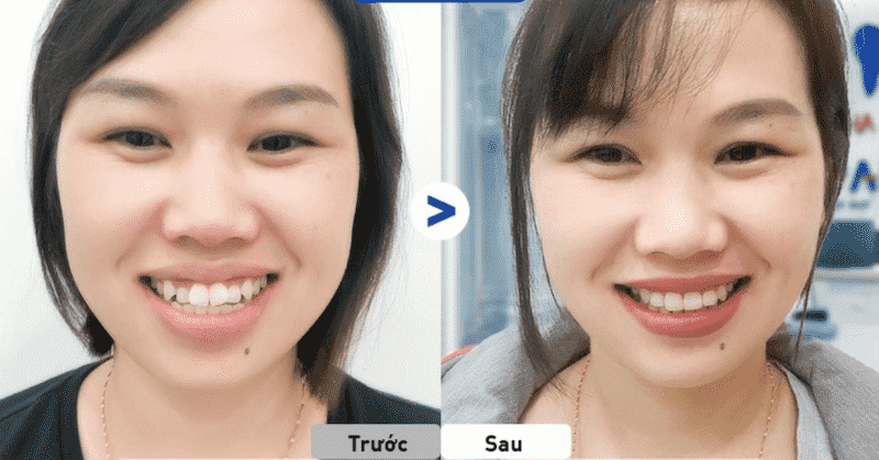 Hàm răng ảnh hưởng rất nhiều đến hình dáng của khuôn mặt