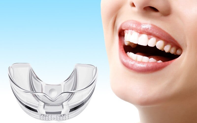 Niềng răng trainer tại nhà là phương pháp chỉnh nha phổ biến hiện nay