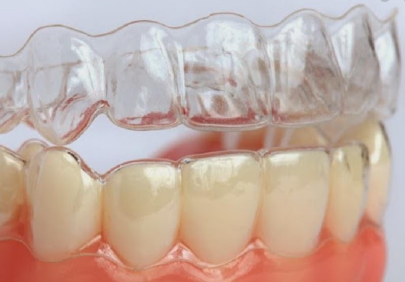 Niềng răng trainer tại nhà được áp dụng cho nhiều trường hợp khác nhau