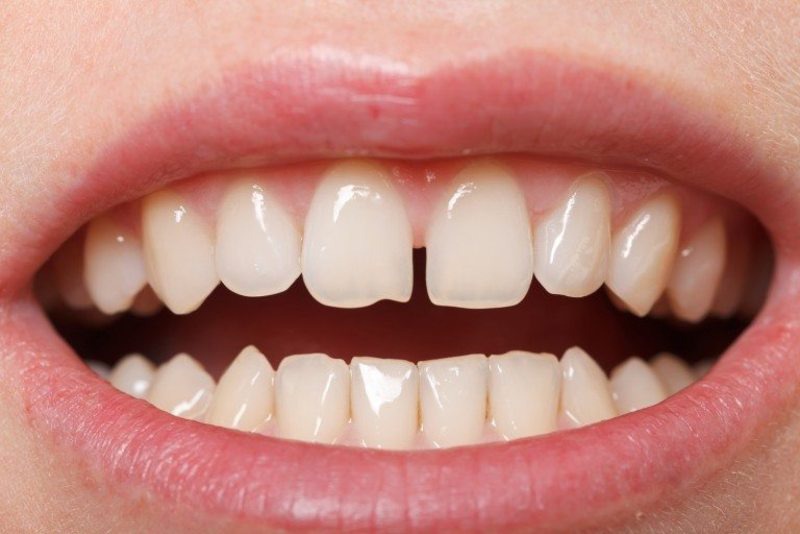 Tình trạng răng thưa có thể sử dụng phương pháp niềng răng trainer tại nhà