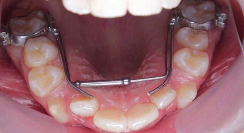 Sau khi nới rộng hàm, răng của bạn sẽ có đủ diện tích để di chuyển