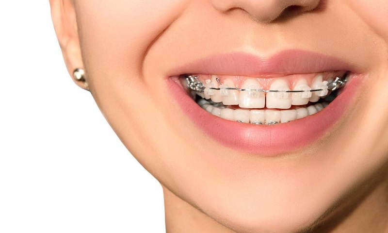 Chi phí niềng răng thông thường sẽ đã bao gồm chi phí nới rộng hàm