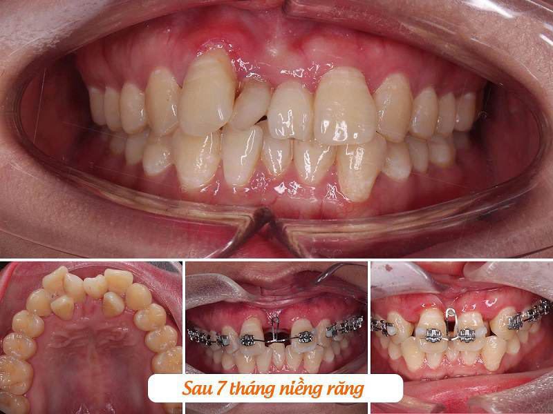 Quá trình niềng răng sau 7 tháng ở trường hợp bị lệch lạc răng nhiều