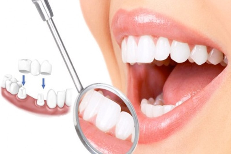 Bọc răng sứ giúp răng lấy lại vẻ thẩm mỹ